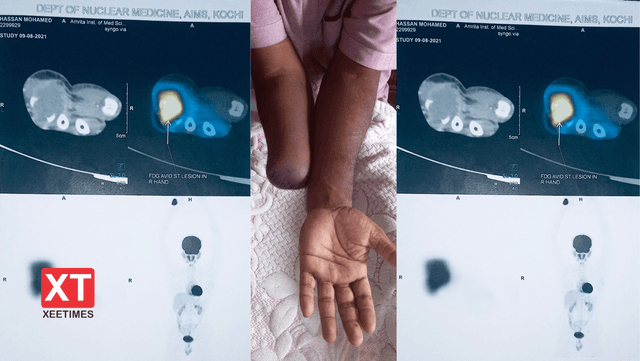ކެންސަރުގެ ވޭނުގައި އަތް ބުރިކުރުން: ހިތްވަރާއެކު ދިރިއުޅުމައިގެން ކުރިއަށް!